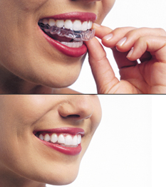 Invisalign Image