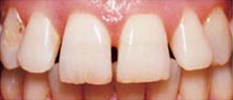 Before Porcelain Veneers